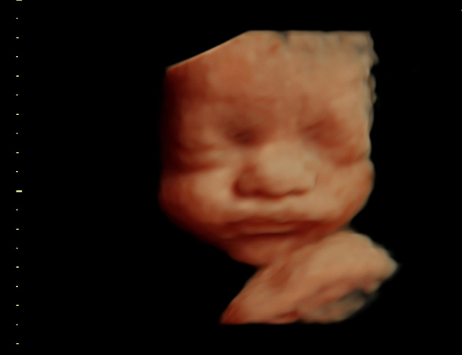 3D ultrasound image at 29 weeks